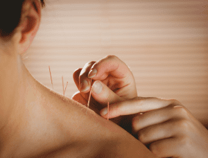 Acupuncture at Prime Therapy Clinic