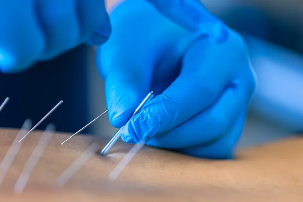 close up of a needle and hands of physiotherapist 2023 11 27 05 29 16 utc